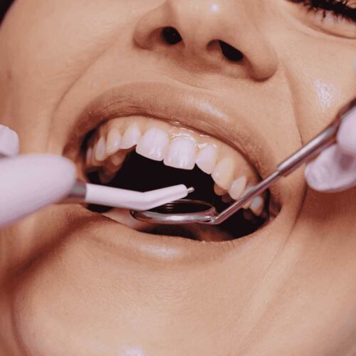 Diş Çekimi